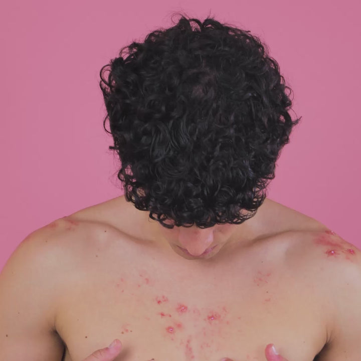 ByePimples Body – Tratament Natural Antiacnee pentru Corp | Eco Bio Boutique