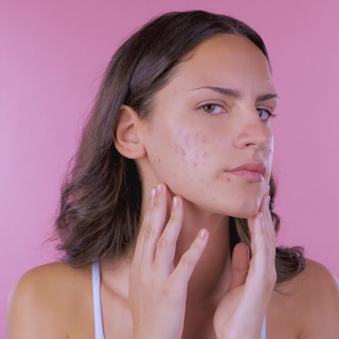 Byepimples – Tratament Natural Antiacnee | Eco Bio Boutique